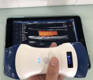 Dual Head Convex & Linear Array Wireless Ultrasound Probe uRason W7