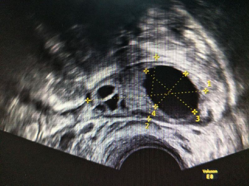 transvaginal ultrasound 6 weeks